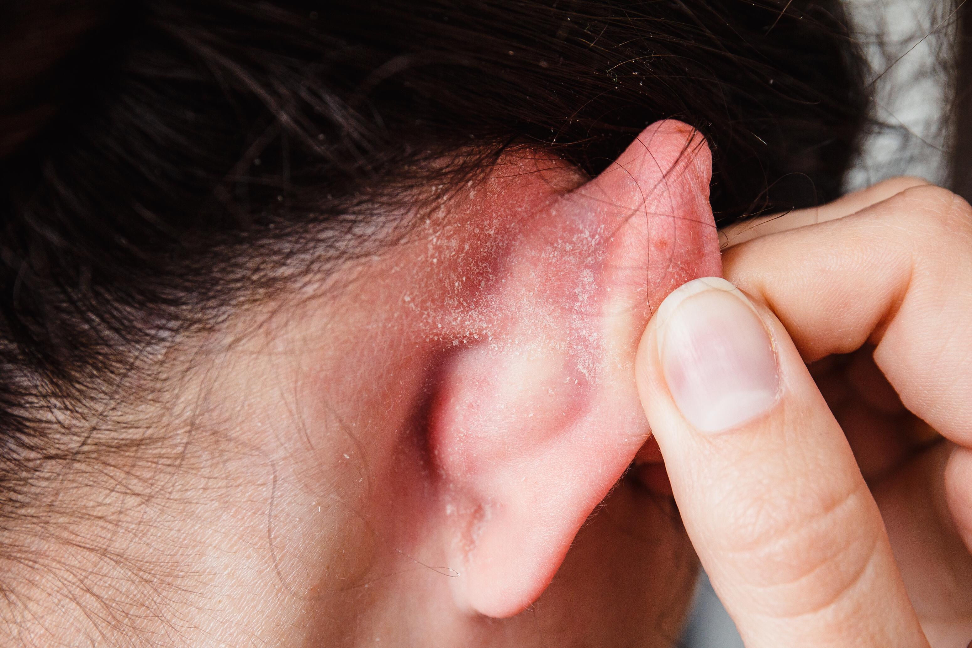 Symptôme du psoriasis derrière les oreilles